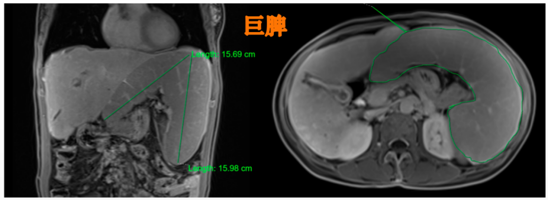 腹部增大没当回事,竟引来脾大,脾亢,消化道出血.