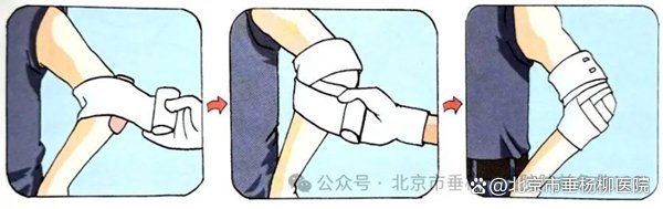 人字形包扎法人字形包扎用于能弯曲的关节,如肘部,膝部,还有手和脚跟