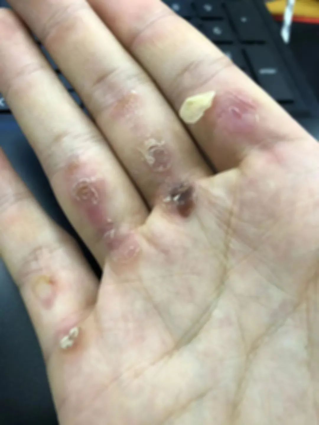 手掌上布满茧子和血泡一次又一次的训练感到钻心的疼他的手反复被磨破