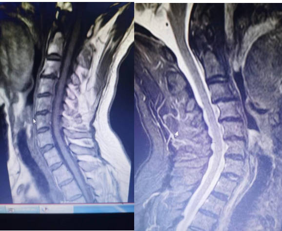 反复胸痛两年,患者生不如死,医生:这个心绞痛不一般!