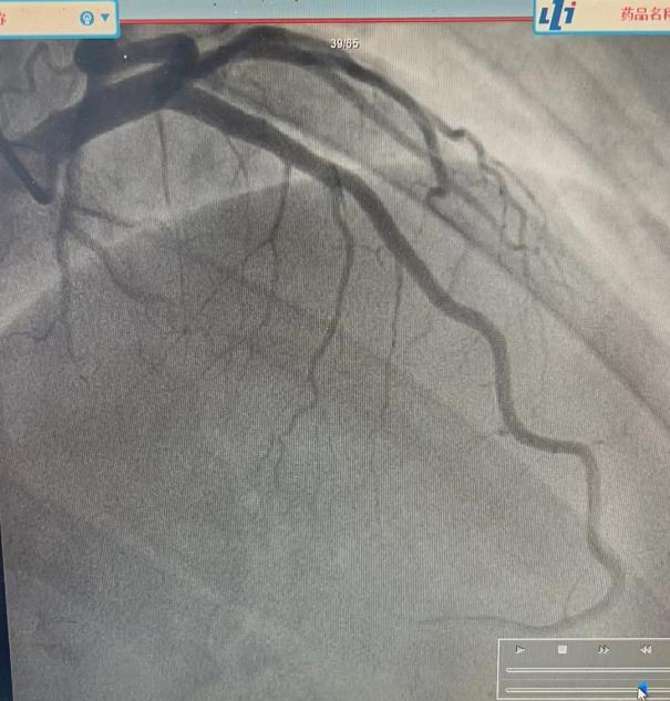 反复胸痛两年,患者生不如死,医生:这个心绞痛不一般!|