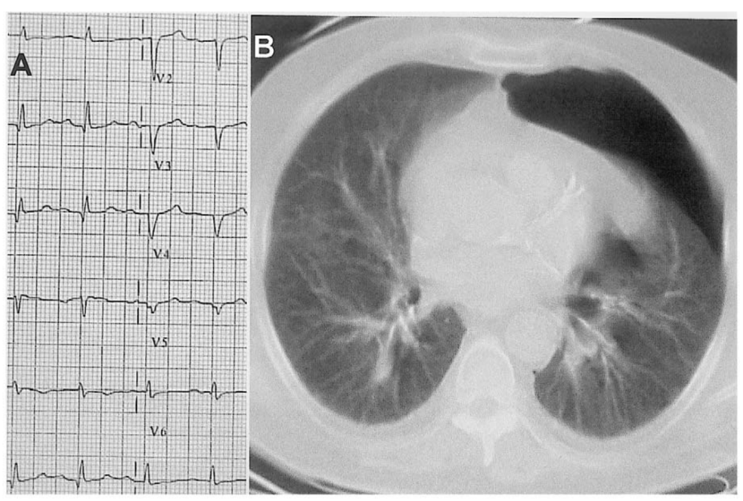 十二导联心电图(图8)显示v1–v4导联qrs低电压和qs形(a),与胸部ct扫描