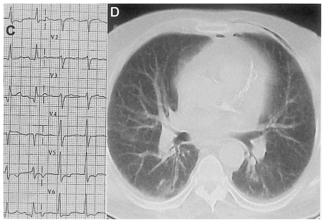 别慌,心电图带你抽丝剥茧找真凶|心电图_新浪财经_新浪网