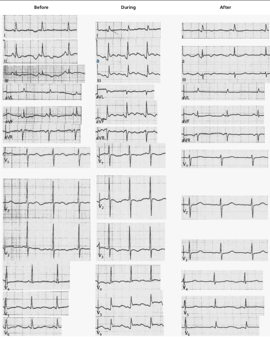 别慌,心电图带你抽丝剥茧找真凶