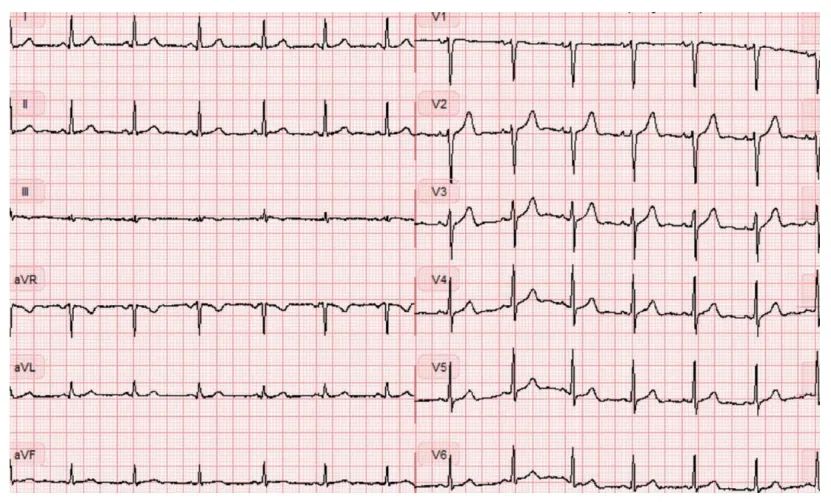 图3患者左侧气胸,入院时心电图:窦性心动过速,v1-v6导联r波递增不良,i