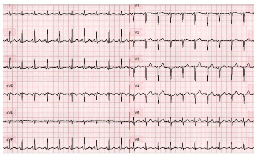 患者左侧气胸,入院时心电图:窦性心动过速,v1-v6导联r波递增不良,i