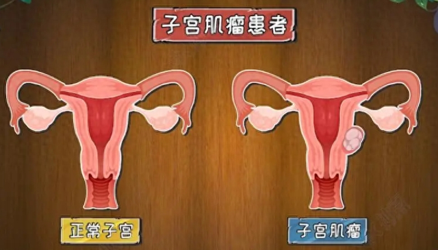 汤医科普|尿频,竟是因为它?|子宫肌瘤_新浪财经_新浪网