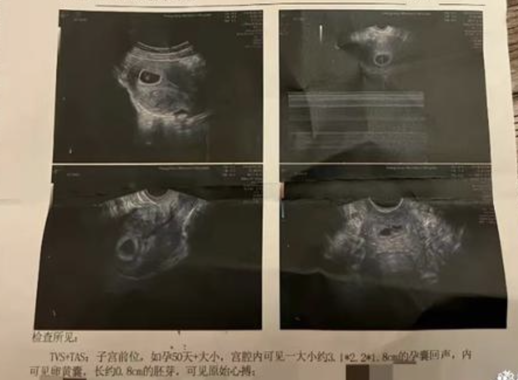 之后杜星霖还晒出验孕棒和彩超单,上面显示杜星霖已经怀孕50天了.