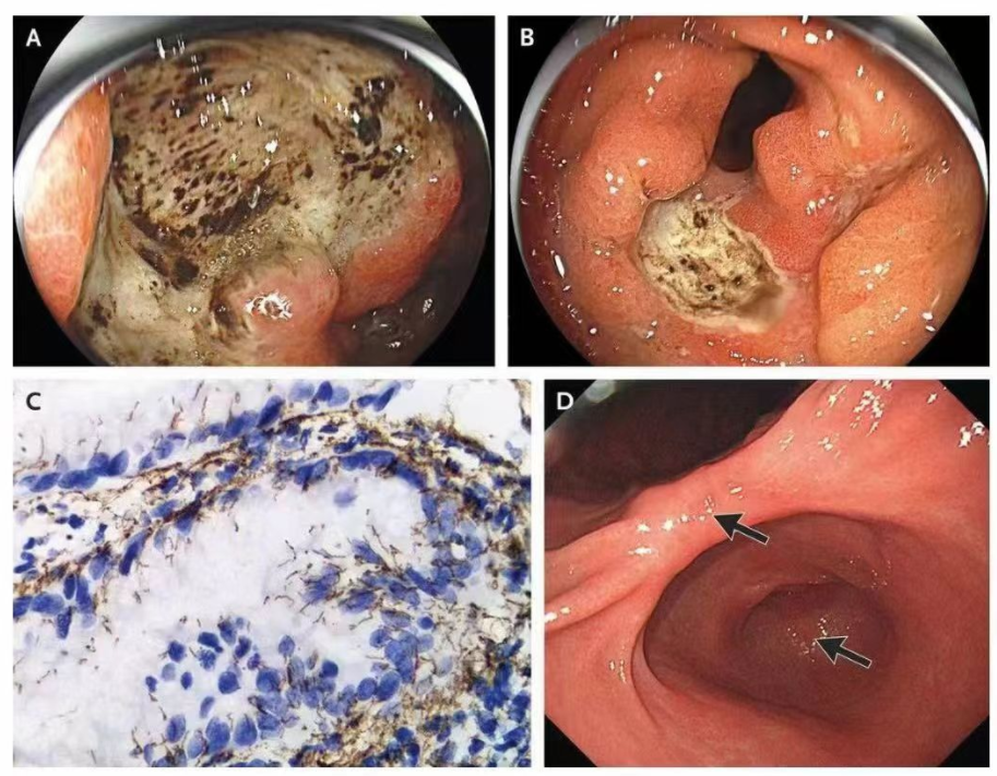 胃里发现梅毒,三甲医院报告罕见病例|梅毒_新浪财经_新浪网