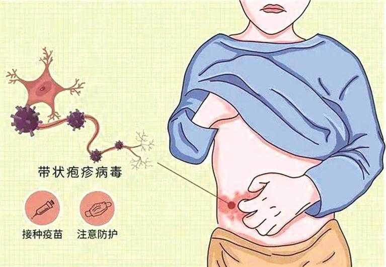 带状疱疹有三大高危人群 接种疫苗是有效预防措施