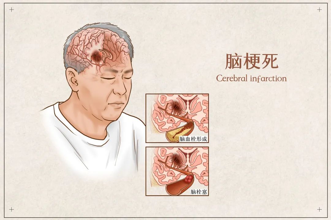 脑梗死还可以采用高压氧治疗 | 科普时间