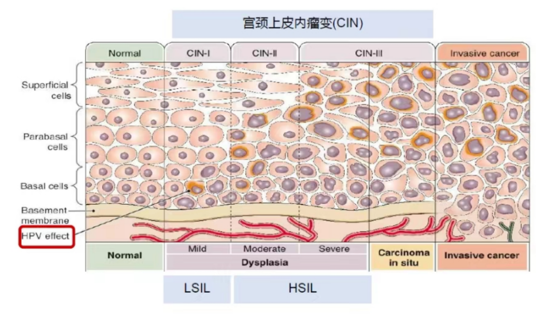图:宫颈上皮内瘤变各阶段