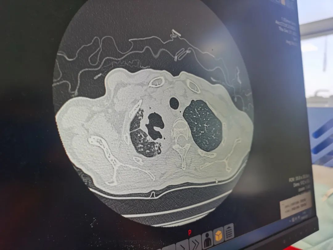▲北京胸科医院，一位肺结核患者的胸片，左右肺迥异，右肺出现空洞和病灶。新京报记者 戴轩 摄