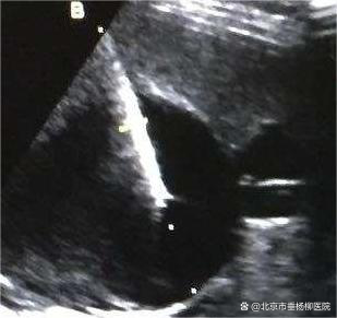 肝囊肿_新浪财经_新浪网