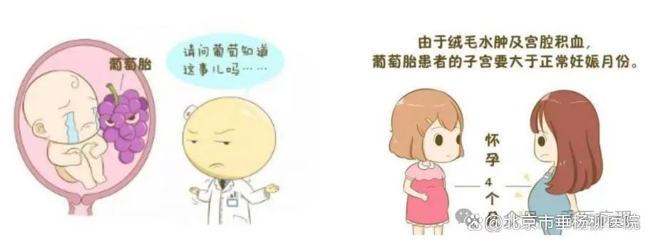 垂医科普|什么是水泡状胎块/葡萄胎?如何精确诊断?