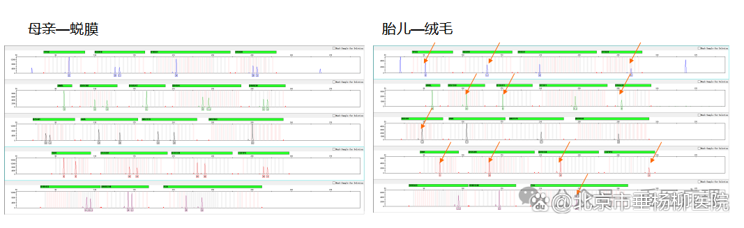垂医科普|什么是水泡状胎块/葡萄胎?如何精确诊断?