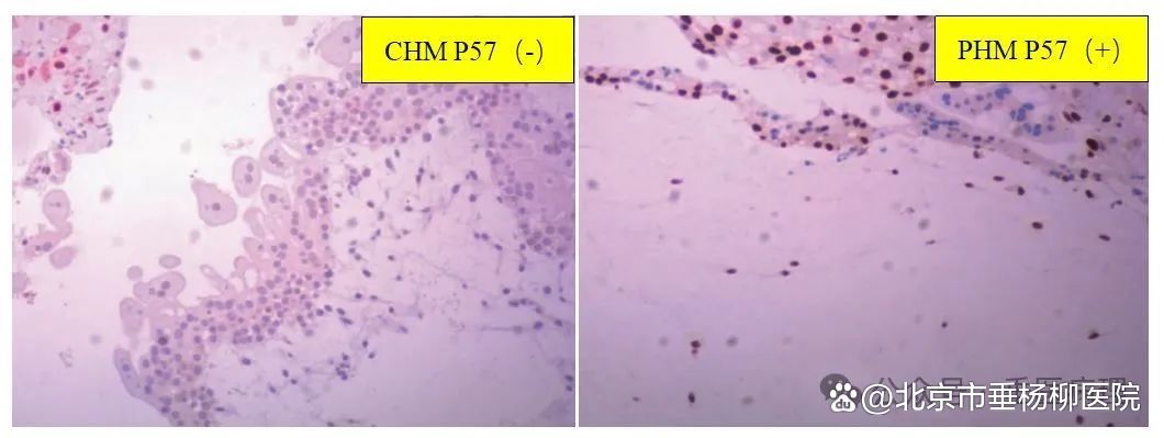 垂医科普|什么是水泡状胎块/葡萄胎?如何精确诊断?
