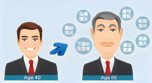 因为生长激素分泌的影响，一个正常人（左）可能表现出的面部畸形（右）。  本文图均为 华山医院 供图