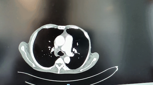 腹部增强CT显示：腹盆腔、腹膜后多发恶性占位