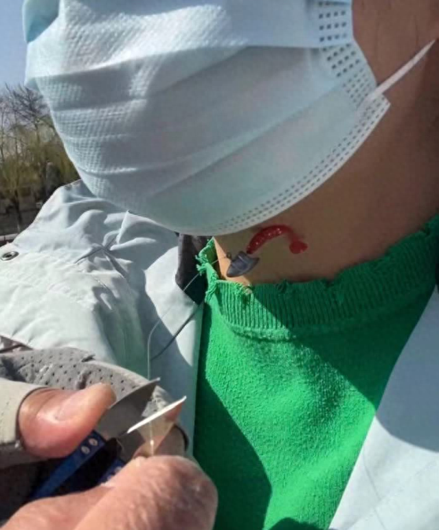 女子亮马河被钓鱼者"飞钩"刺伤颈部!伤口位置太吓人