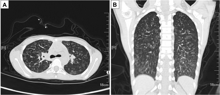 图2 A，胸部CT扫描（横断位）和（B）胸部CT扫描（冠状位）均显示双肺弥漫性结节状磨玻璃影，边缘模糊。