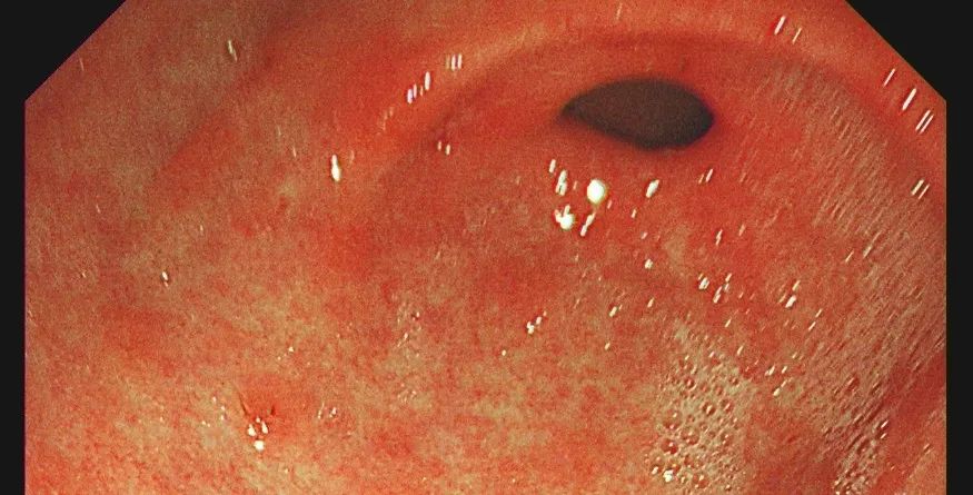 幽门螺旋杆菌感染后的胃,图片来源:作者