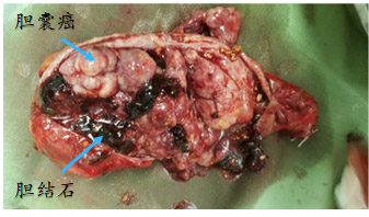 这种癌起病隐匿,如何发现?重视其"小弟"胆囊结石