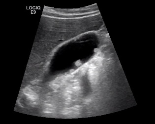 这种癌起病隐匿,如何发现?重视其"小弟"胆囊结石_新浪财经_新浪网