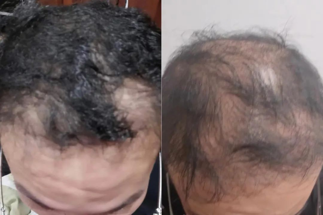 袁子义进行植发手术前后的头顶头发对比，左图拍摄于2022年1月初植发手术前，右图拍摄于2023年10月。受访者供图