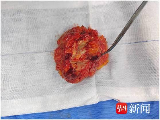 不是乳腺癌,她却被切除了一侧乳房,这种"死不了却让人受尽折磨的病"