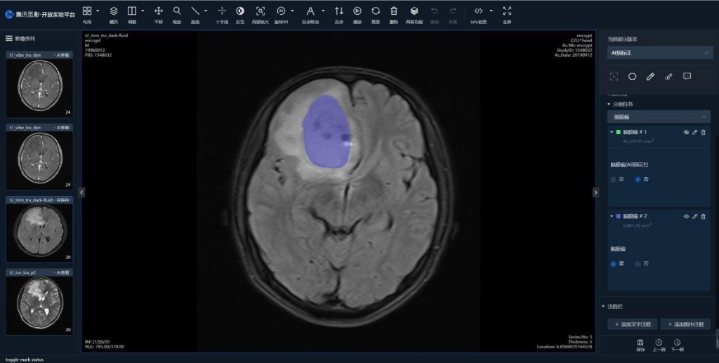 通过平台可标注脑膜瘤磁共振图像等10种疾病医学影像。