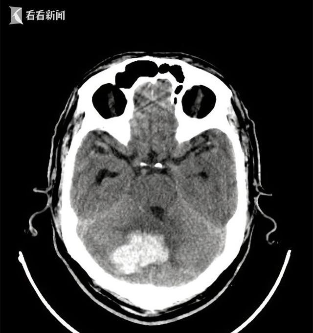 图3.头颅CT示右侧小脑半球脑出血