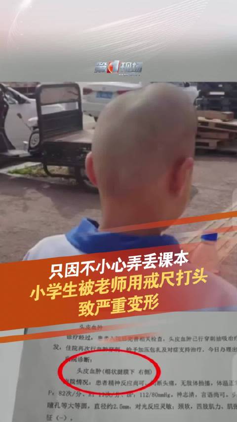 用椰子和西瓜打头哪一个更痛 椰子和西瓜打头哪个疼痛更明显