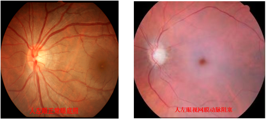 95后女子一觉醒来右眼失明,已错过最佳抢救时机
