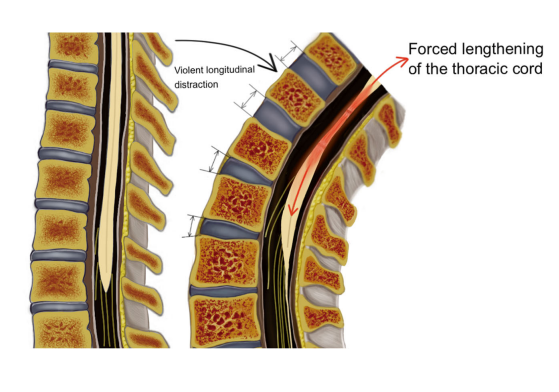 过度纵向牵张，导致脊髓被拉伸