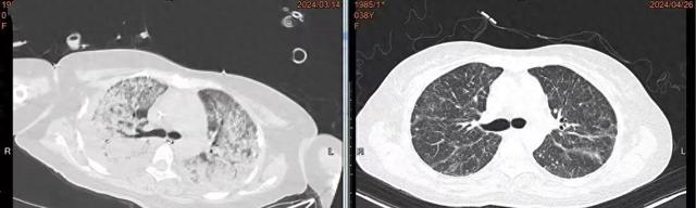 左图是患者的白肺影像，右图为患者出院前肺部恢复正常的影像
