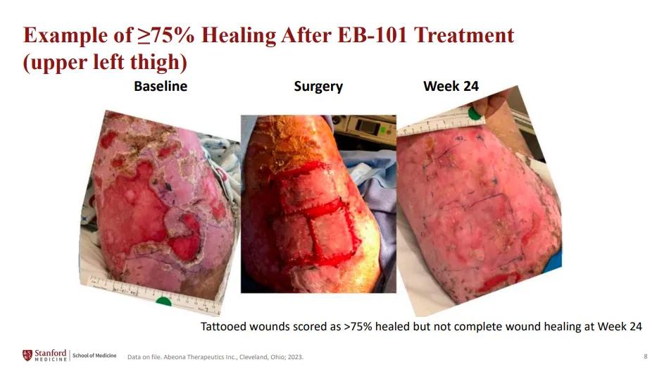 ▲接受pz-cel治疗后，显示出≥75%愈合程度的伤口（图片来源：参考资料[3]）