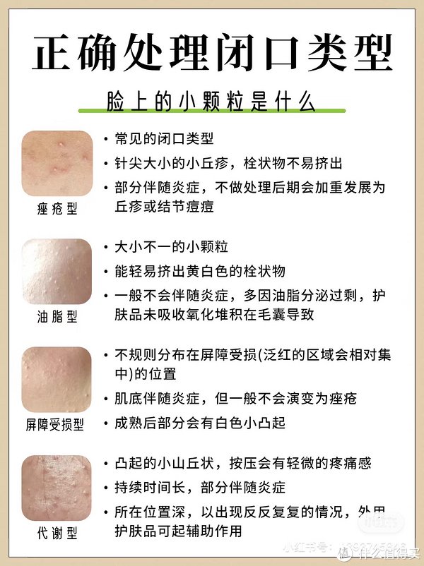 怎么分辨闭口和粉刺|护肤品_新浪新闻