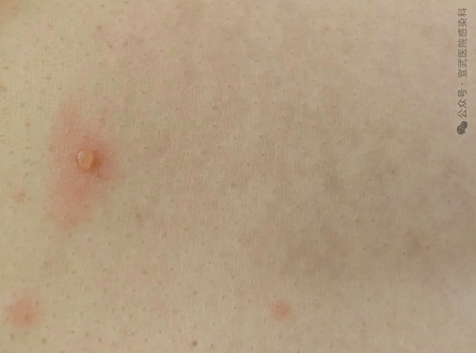 15至19岁人群水痘发病率显著上升!这几件事要了解