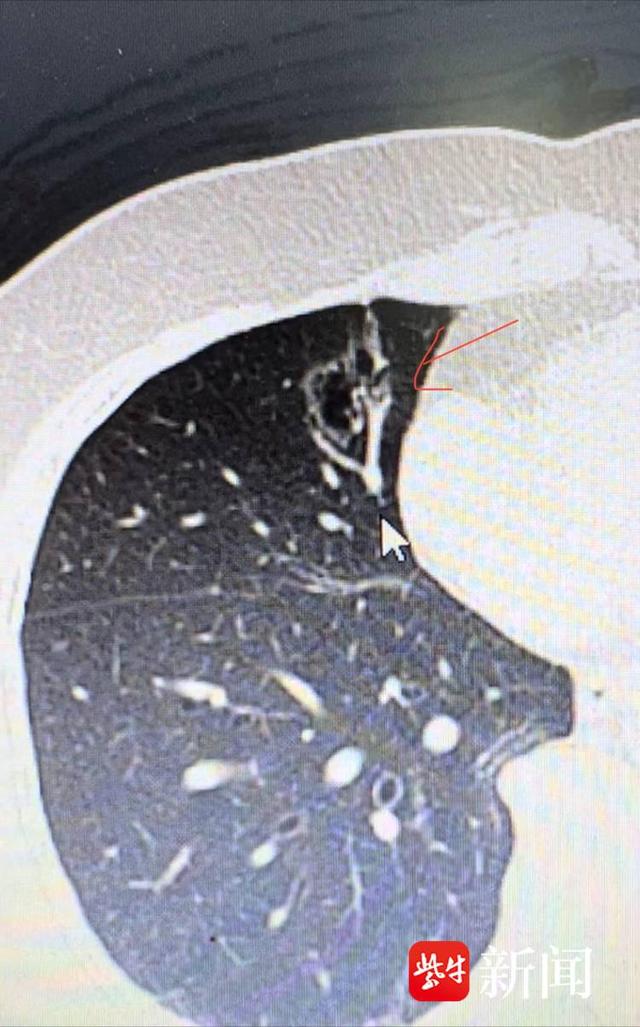 在上海市肺科医院复查ct,同样显示其右肺中叶有囊泡状结节,直径约