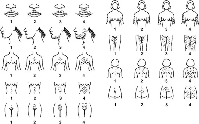 为什么有的女生体毛比男生还多啊啊啊?小心这种病!