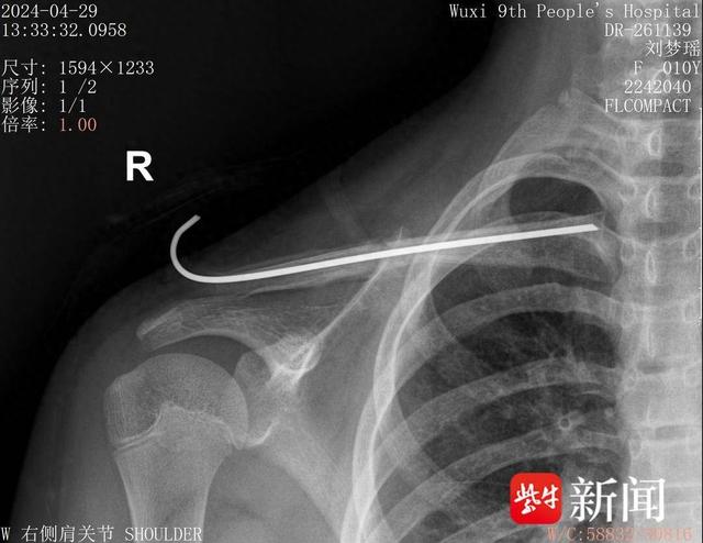 锁骨骨折,机器人规划路线"按图索骥"精准手术