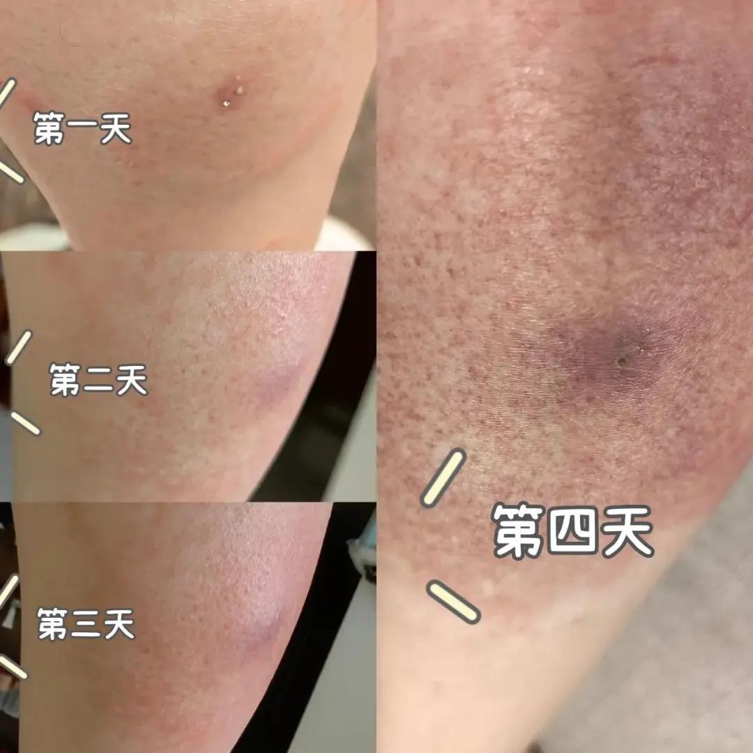 被红火蚁叮蜇后的伤口.图源:受访者提供