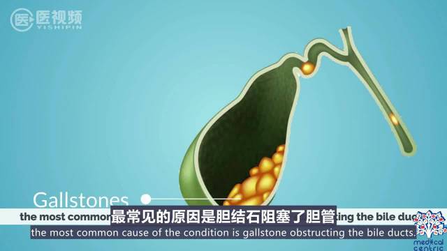 医学双语科普:胆囊炎的病因、体征和症状、诊断和治疗|胆囊炎|胆结石|胆囊_新浪新闻