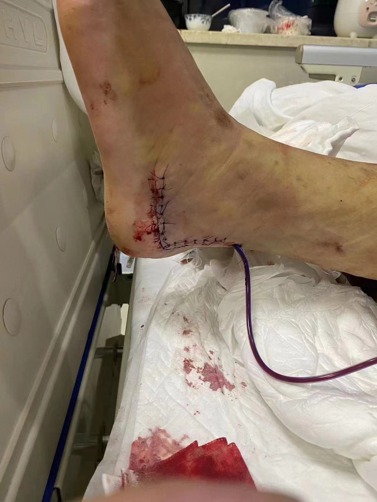 法治面 | 民警与嫌犯搏斗摔伤,应认定"公伤"还是"工伤"?