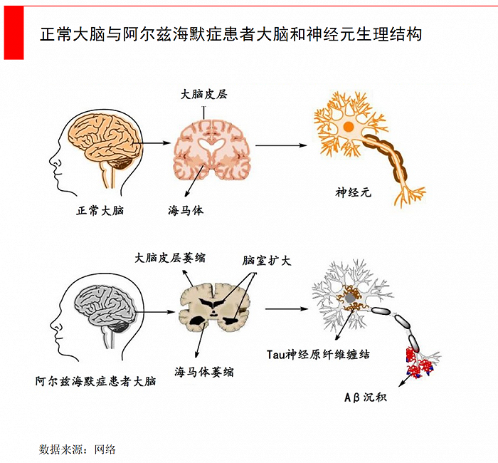 当某些基因出现bug,阿尔兹海默症有哪些新突破?_新浪财经_新浪网
