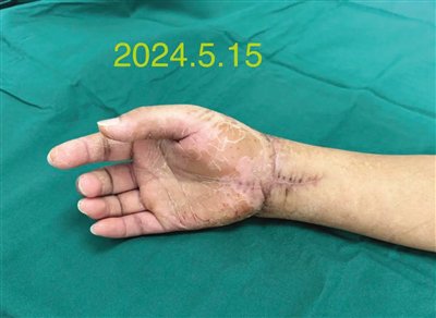 本报讯 不久前,万宁女子曹女士(化姓)被他人砍断右手腕及砍伤头,颈,肩