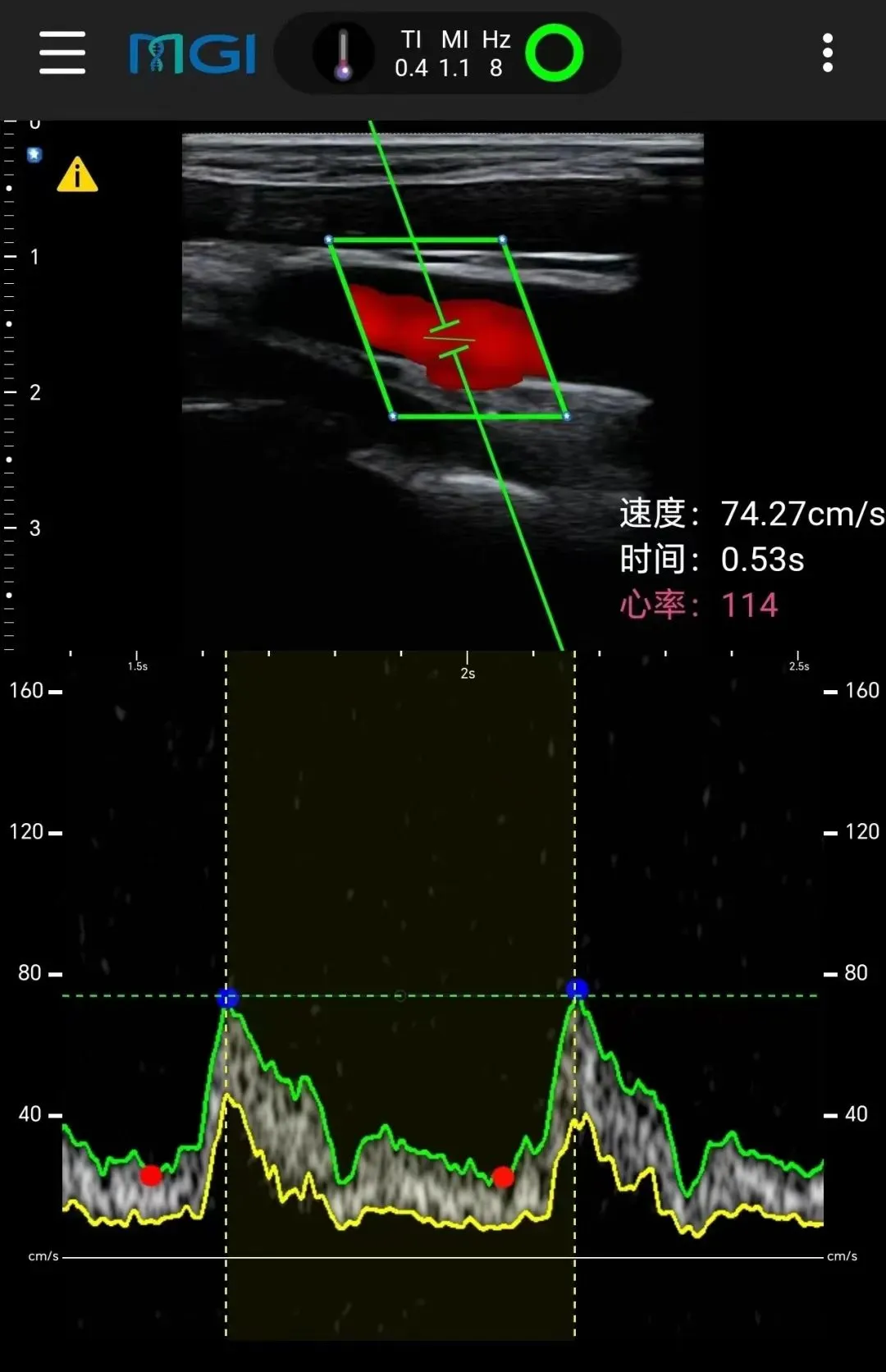 在珠峰顶实时获取的颈动脉超声扫查图像。图片来源：华大基因