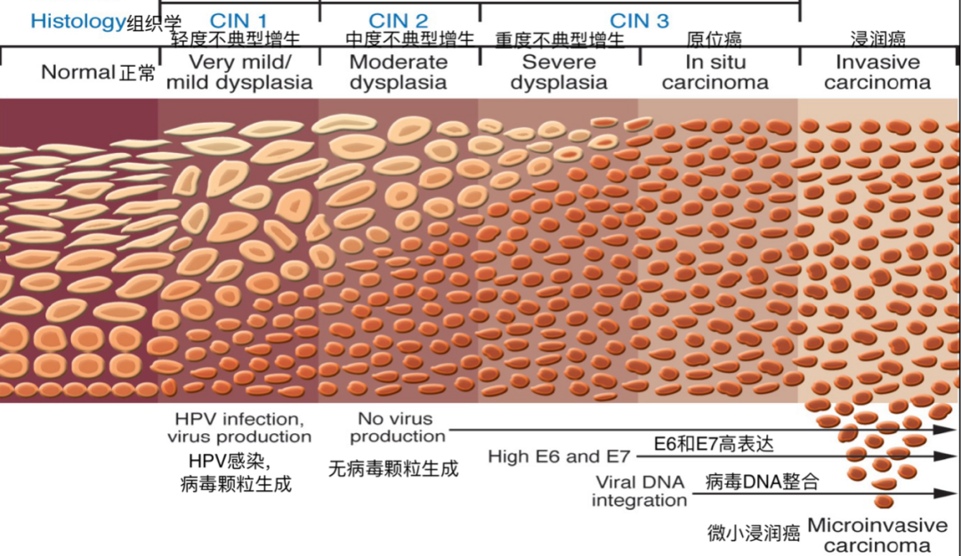 cin1 又名极轻/轻度不典型增生(very mild/mild dysplasia),此类病变