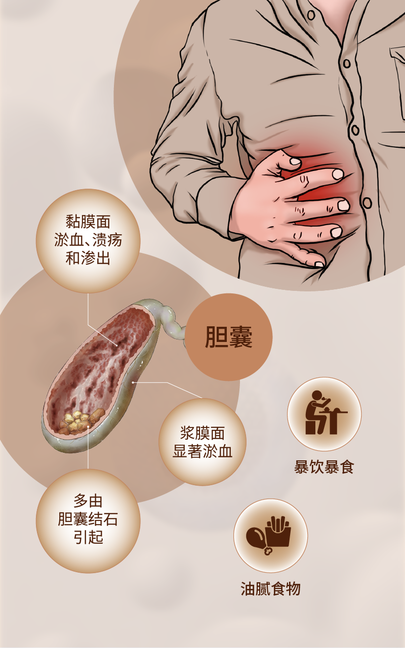 科普|急性胆囊炎怎么治,如何防?|胆囊结石|疫情|胆汁|切除术|胆道_新浪新闻